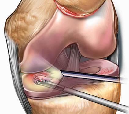 سعر استئصال الغضروف الهلالي في تونس